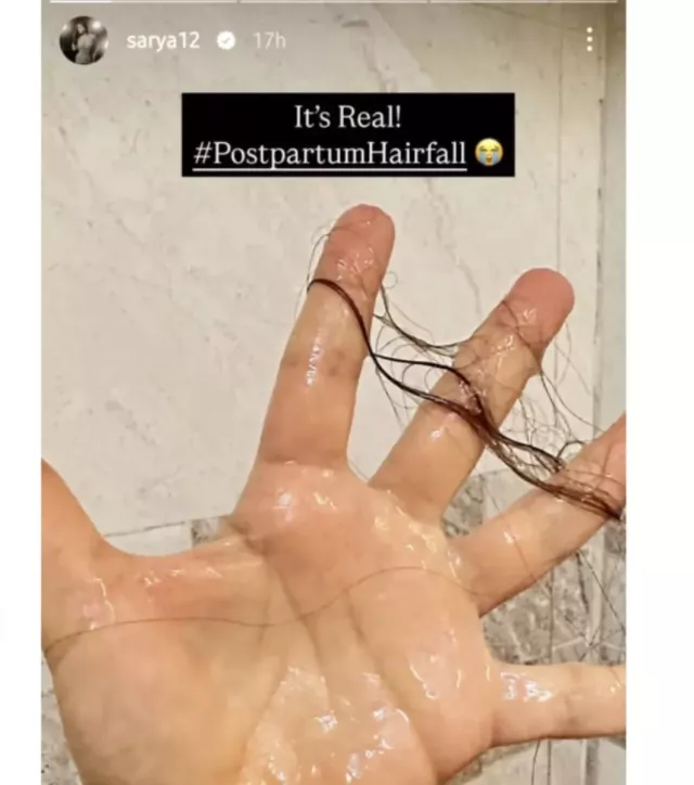 shraddha arya postparum hair loss